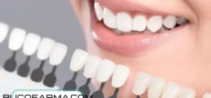 ¿Cuánto dura un blanqueamiento dental